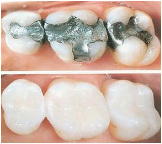 bonded fillings