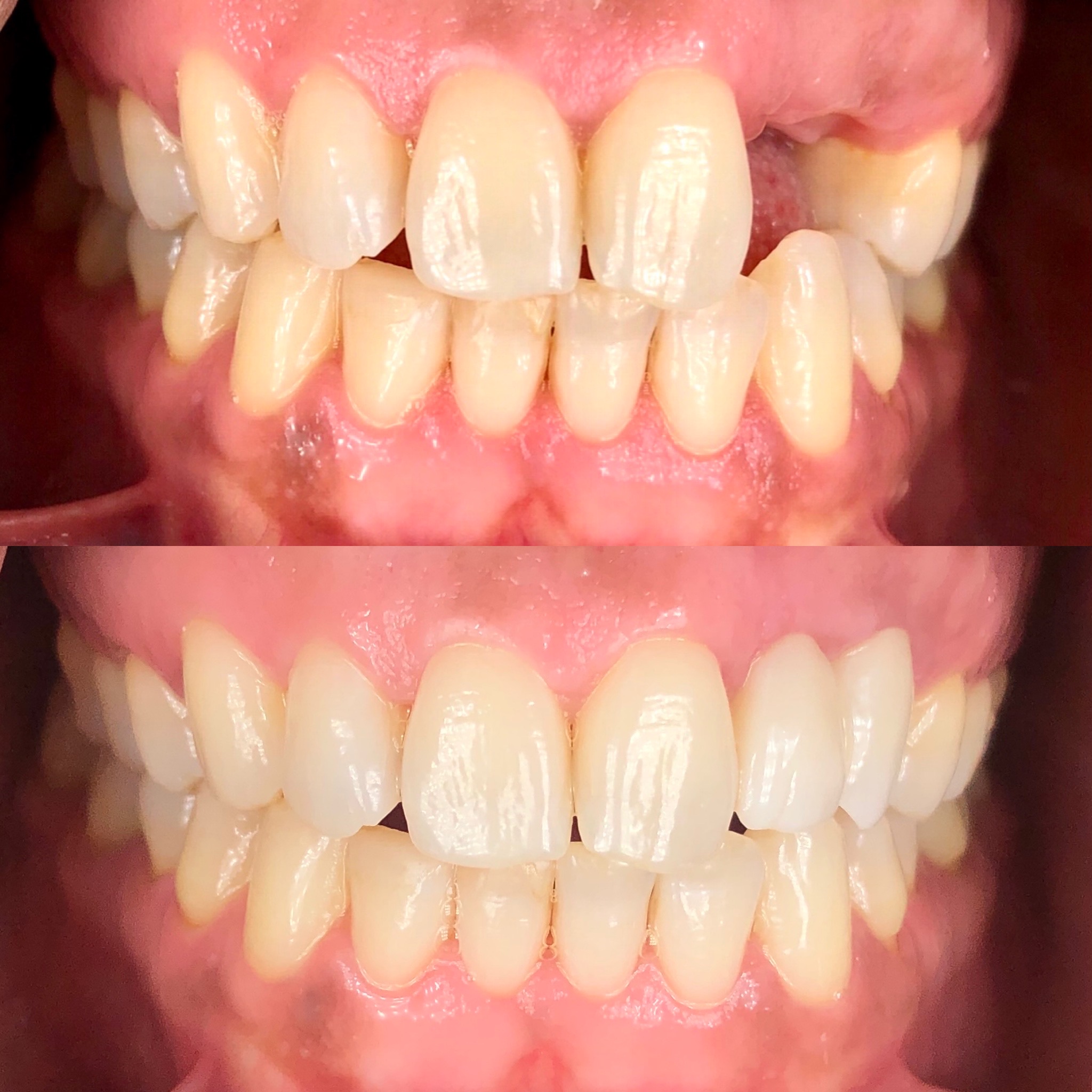 Dental implant before and after