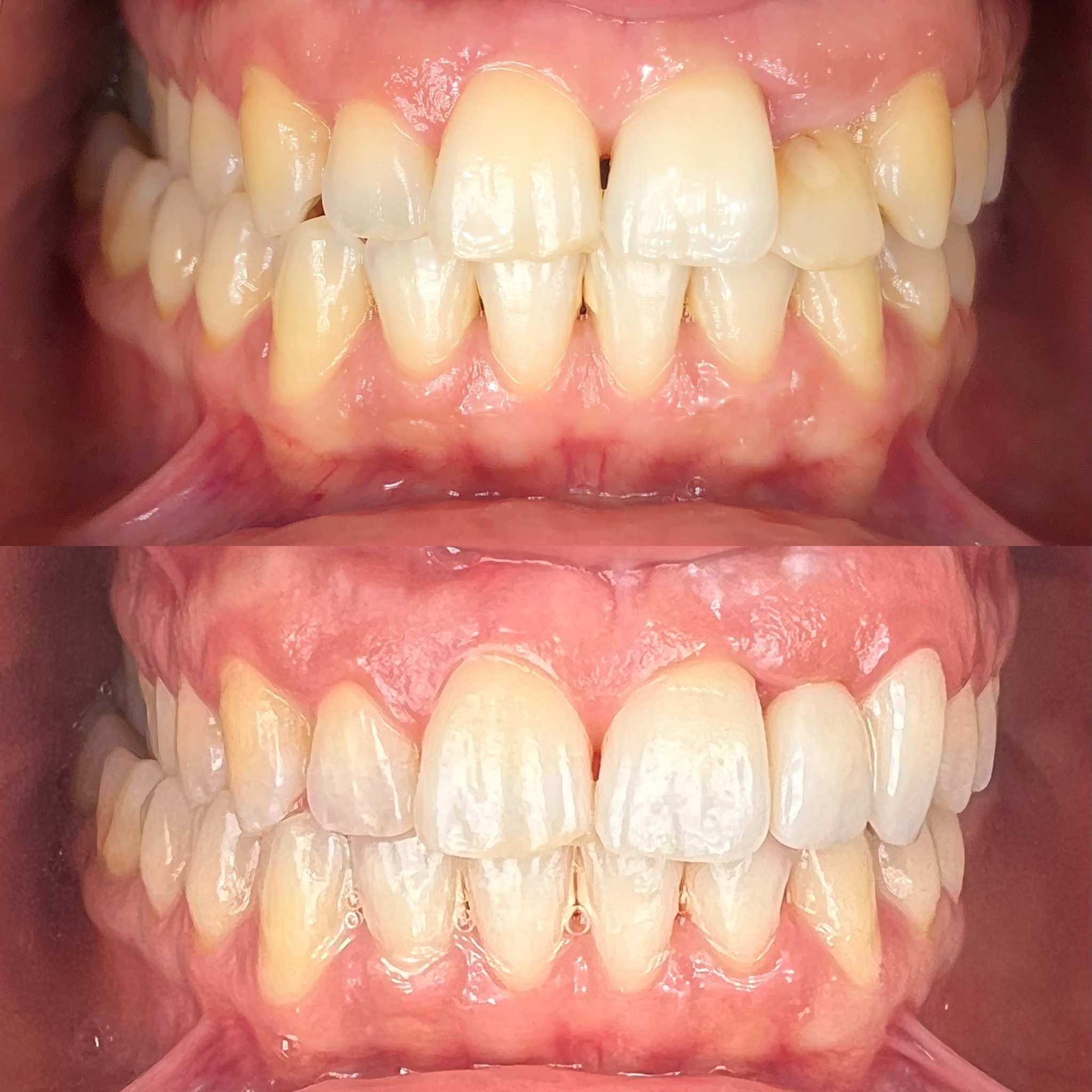 permanent dental implant patient