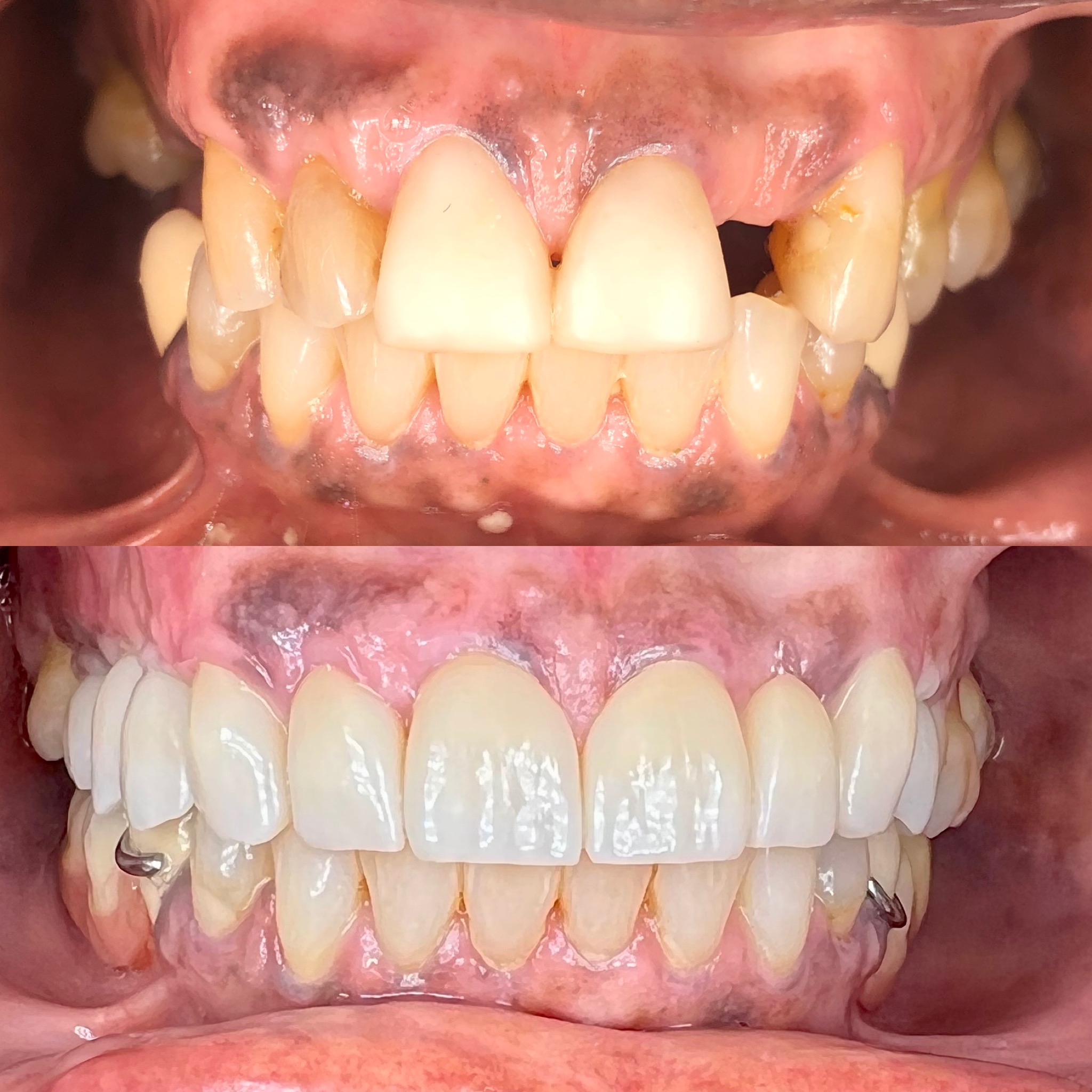 dental implant patient before and after