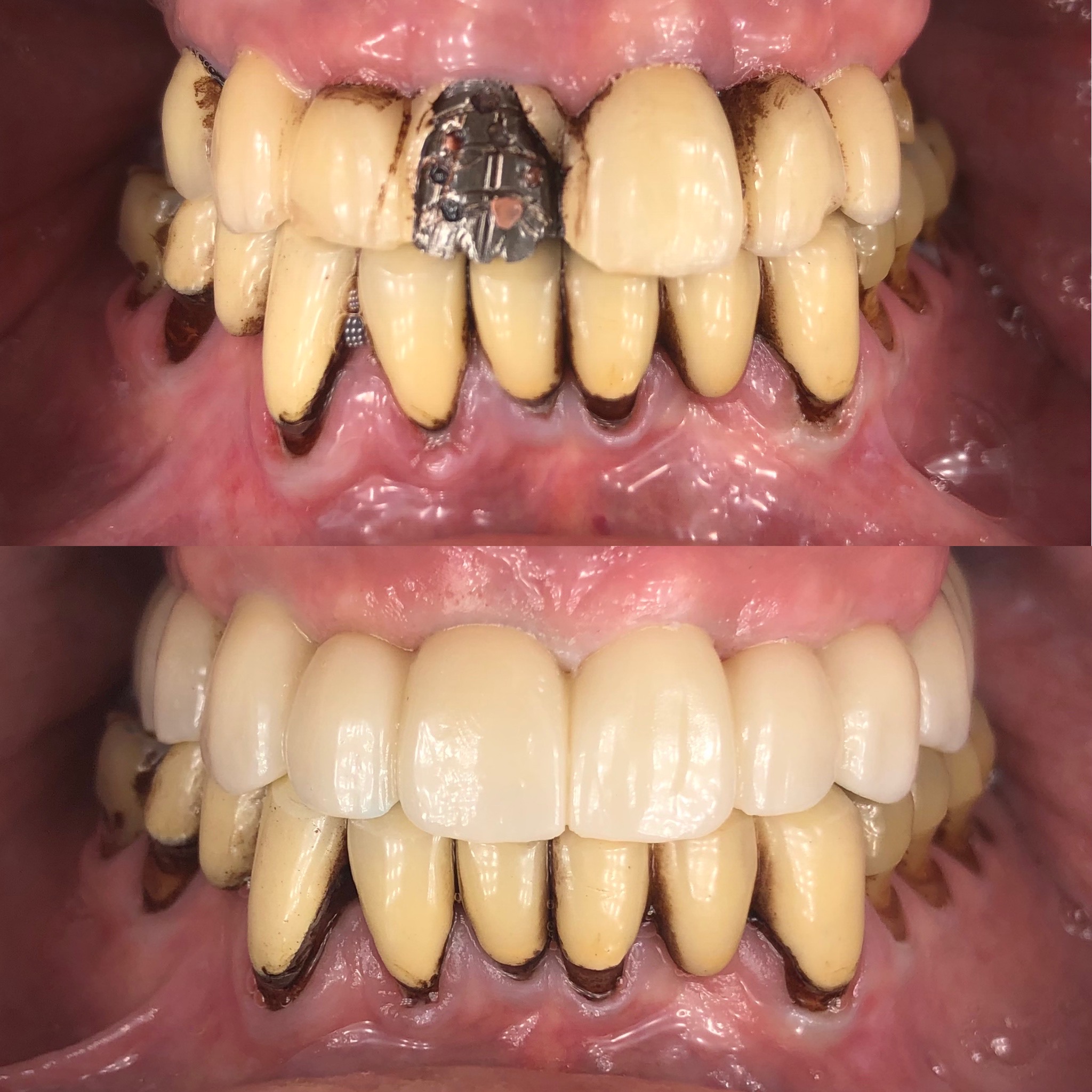 dental implant patient before and after