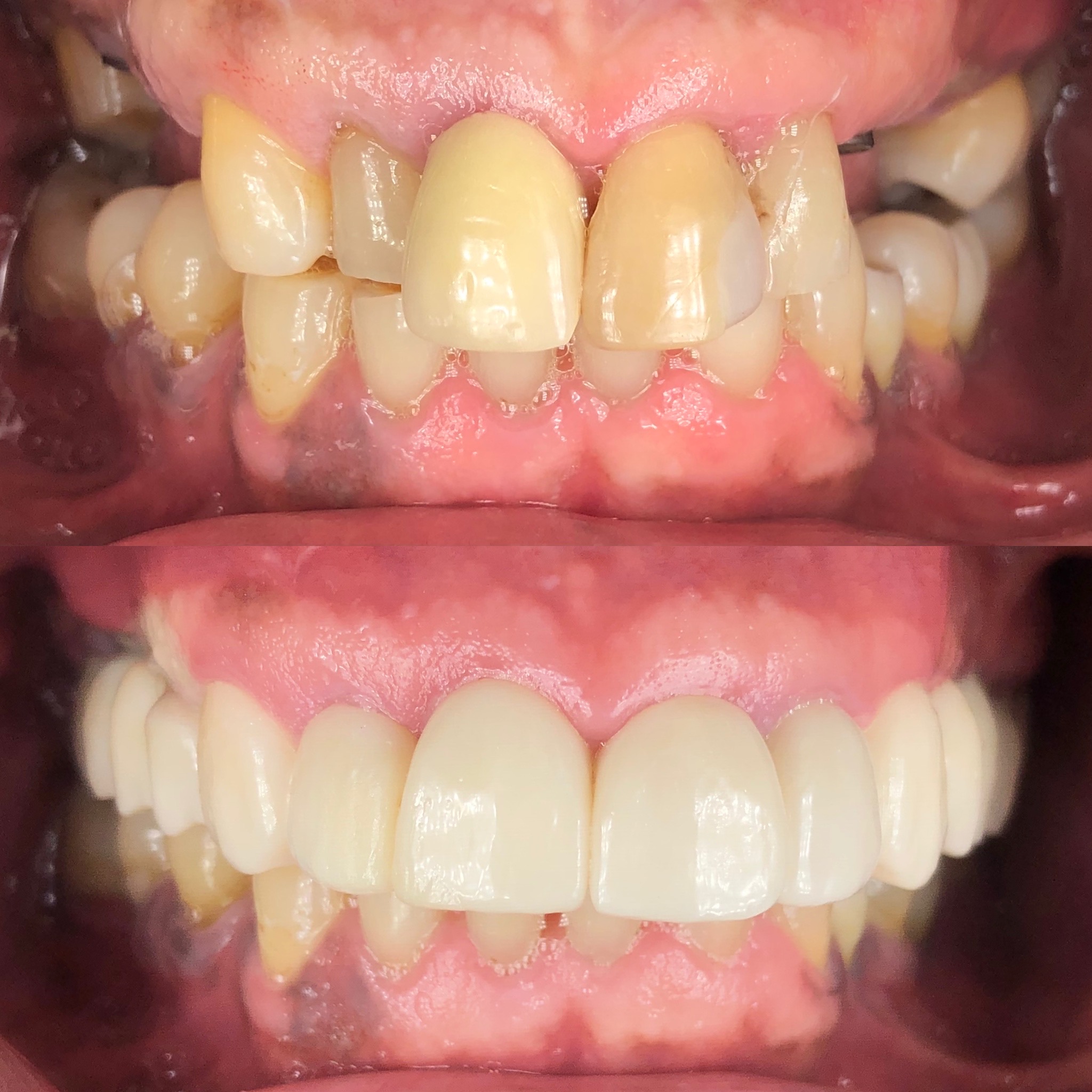 crown and dental implant patient before and after