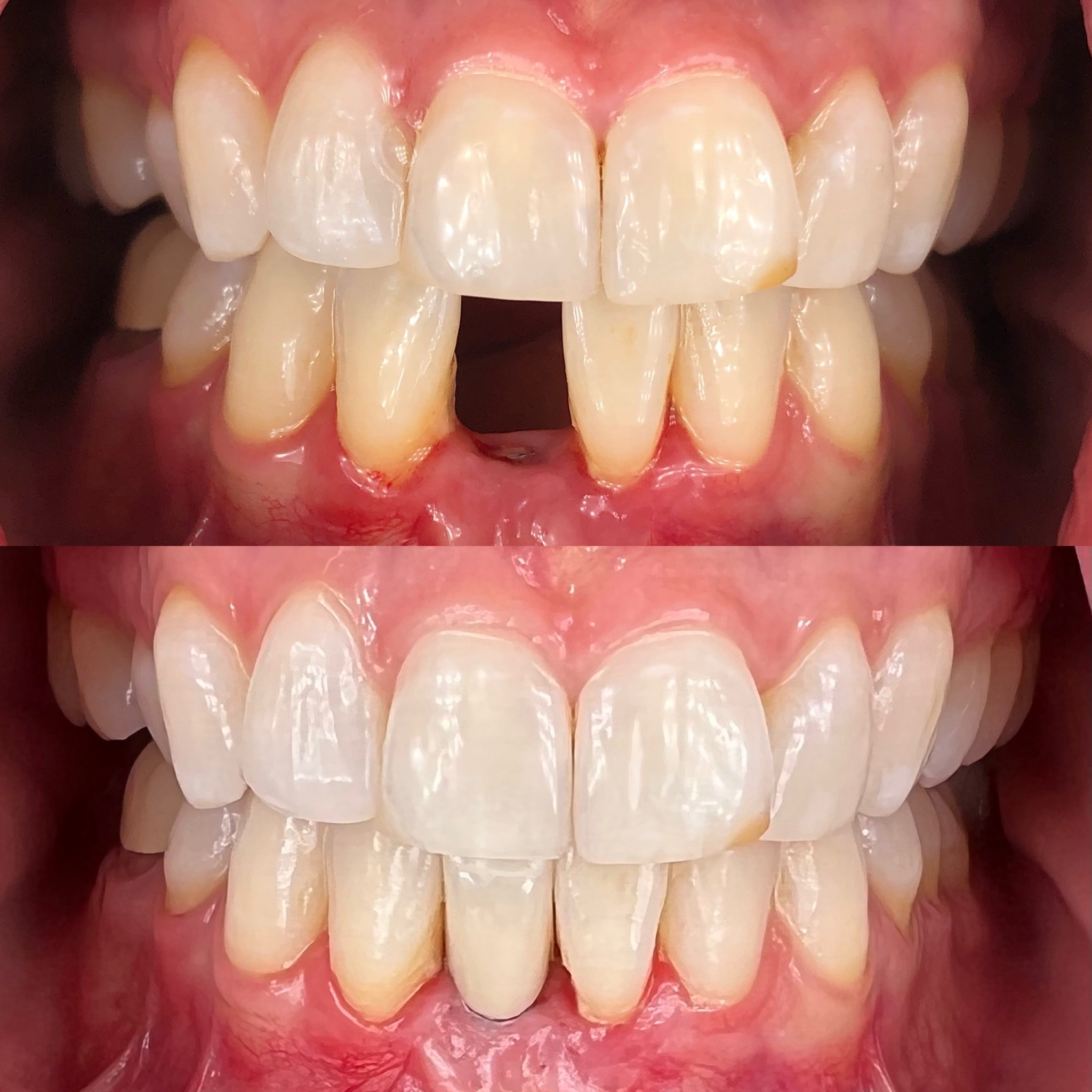 dental implant patient before and after