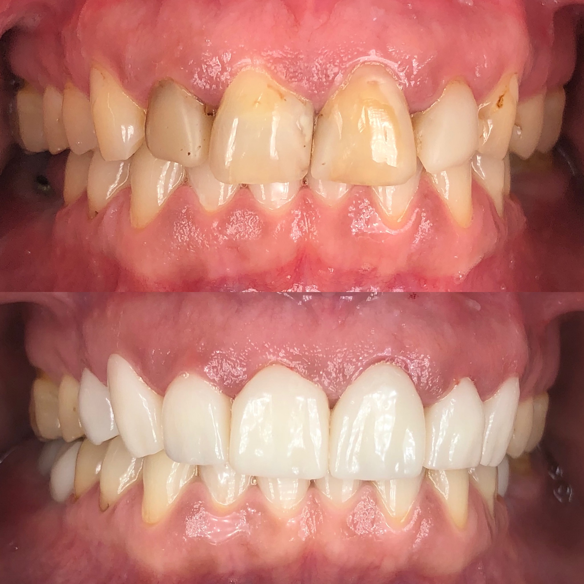 dental implant patient before and after