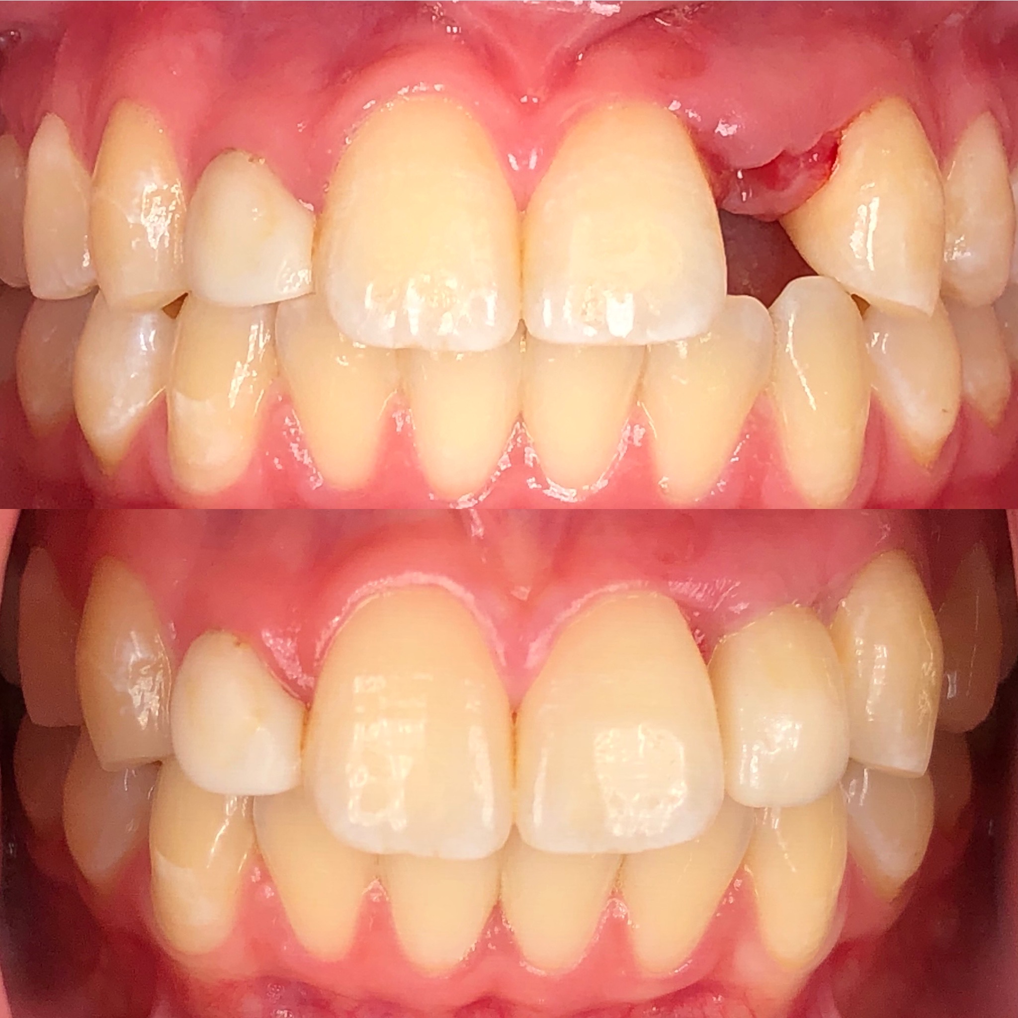 dental implant patient before and after