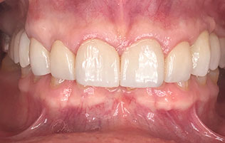 dental patient after veneers