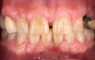 dental patient before veneers
