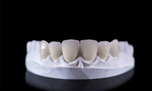 porcelain veneers on a dental tooth model on a black reflective table