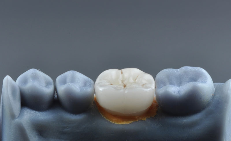 Single tooth color restoration , lithium disilicate crown on posterior tooth on tissue cast