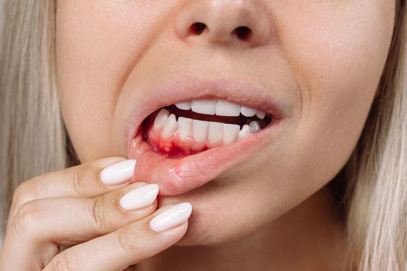 Gum inflammation. Close up of young blonde woman showing red bleeding gingiva with an ulcer holding her lip.