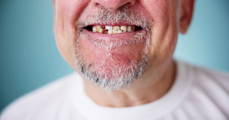 Smile With Missing Tooth. Broken Tooth Absence