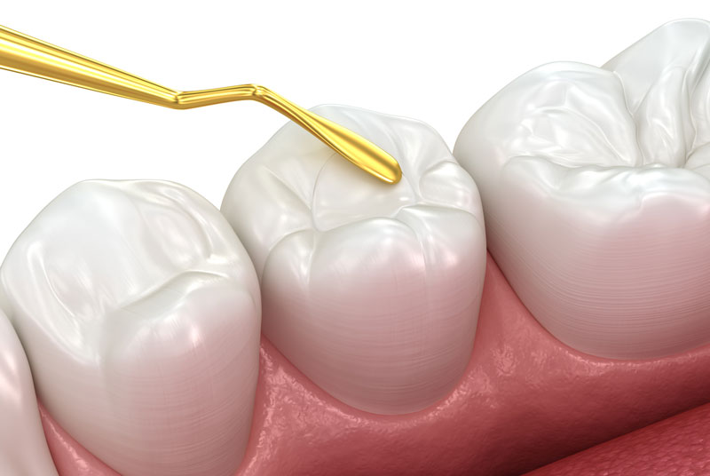 Toth restoration with filling. Medically accurate tooth 3D illustration.