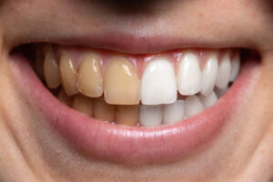 Close-up of a smiling mouth showing a comparison of stained teeth on the left side and whitened teeth on the right side, illustrating teeth whitening results.