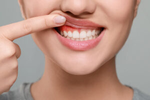 Inflamed red gums above teeth, early sign of gum disease or gingivitis.