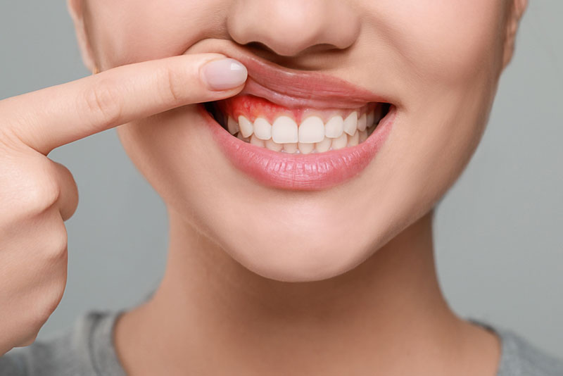 Inflamed red gums above teeth, early sign of gum disease or gingivitis.