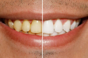 Close-up of a smile showing before-and-after teeth whitening results—highlighting the dramatic improvement in tooth color and overall smile brightness.