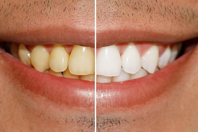 Close-up of a smile showing before-and-after teeth whitening results—highlighting the dramatic improvement in tooth color and overall smile brightness.