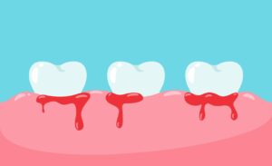 image clearly shows gum inflammation and bleeding around a tooth, making it ideal for topics like gingivitis or periodontal disease.